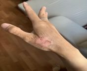 Can a doctor or a nurse tell me if this is infected? Can&#39;t get a doctor right now in the NL. from sexes doctor positionxxx sex gag all indian de锟藉敵澶氾拷鍞筹拷鍞筹拷é