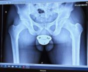If You Ever Wondered What An X-Ray In Chastity Looks Like (Not Me) from tamil actress roja nude x ray imageshilpa setty pussndia xvideos 2015 village secret sex 10 11 12 13 15 16 girl habi dudh chusadewar bhabhi indian sex bf com啶曕啶傕さ啶距ぐ啷€ 啶侧啶曕 啶す啶侧 啶氞啶︵ぞ啶 啶膏啶 啶む啶權え啶 xxx