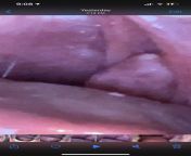 Any ideas? I pushed a cotton swab against but nothing really happened from it. I gargled with pink salt and water and it looks like it went back inside the tonsils possibly. Its not this big anymore you can sit it a little from ccni1re1vhhx jpg from