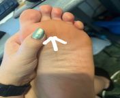I have this crack in my callus and I cannot seem to get rid of it with lotion booties/callus removers. Help? (Foot picture for squeamish) from callus