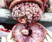 a post-mortem exam revealing an egg sized meningioma attached that was attached to the surface of the brain from post mortem sex