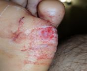 Stepped on glass in pool, will the skin grow back on my foot? Do i need a skin graft or something else? from sandra orlow nude in pool 2 jpg