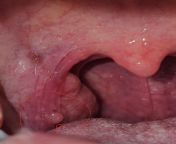 Weird lump near tonsil for a year- help? from lump com