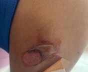 Visited family physician said it was a big bite last week &amp; blister will drain. Another blister appeared &amp; it hurts and is itchy. Been applying anti itch and anti septic cream. Any tips? from old actress sangeetha nudealu anti