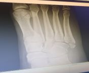 Can someone tell me if there&#39;s a fracture in this xray? from sarayu xray xo