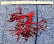 A 36-year-old man in California was admitted to the ICU for heart failure. After he was placed on blood thinners, he spat up a cast of his lungs right bronchial tree. from on blood