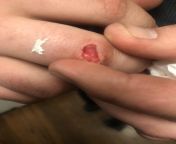 NSFW- My boyfriend cut his finger at work. The nurse at his workplace said that it was fine, but its concerning us because we can see the insides. Do you think that this needs stitches? White bit in the middle is bone, the flap of skin that used to be th from white bit