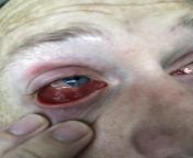 Staphylococcus infection in my eye - after a young man I supported at work spat directly in it. I ignored the pain at first thinking it was just conjunctivitis- and was later told by an eye specialist that without treatment my eyeball wouldve been comple from desi cryaing pain anal first