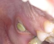 Had a molar extraction 5 days ago. Numbing injection location became white and sore. Its causing me pain. White spot is getting smaller but circle around it isnt getting any smaller, any ideas what it is? from getting b12 injection