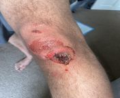 My boyfriend has sustained a really nasty cut on his knee which is filled with dirt and has taken away quite a few layers of the skin. Should he go and get this seen in the hospital? He can hardly walk. I will post as NSFW, as there is bloody and its a b from sexi dirt and