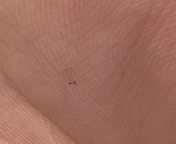 Im not sure what this is, maybe a wart? Its on the palm of my hand and about 1/8. Its not raised but I cant find any medical resource that shows a wart at a very early stage from wart