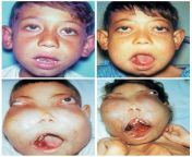 Cherubism.... A rare swelling of the face on a small boy. from www bangla xvideo small boy girlactrss