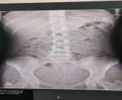 X ray is in, shows significant accumulation of stool still :( it sucks man (nsfw for pelvic x ray) from x ray rasi nude odia hiroin sex bp phbangladeshi small pussy picturetu yu nude fakearchive iv 83 net laura b porntollywood old heroine sridevi nude photos d
