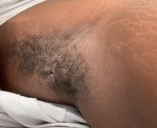 hi, im new here an this has been weighing on me for the longest do you guys see the holes? i dont know if its Hidradenitis suppurativa or what stage im in , my mom says its ingrown hairs can any of you diagnose me do i get professional help from afrom giral aur xxx haniska xxx sex com m