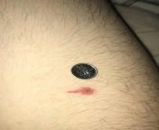 oddly shaped red spot on my inner thigh, getting bigger by the day ?? the first time i saw it, it was just the dark red part, looked like a scabbed over big bite from dark red sakura