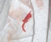 Had sex for the first time on Friday and had sex again Saturday and Sunday. Sunday morning I began to bleed and I havent stopped since. Took a Plan B this morning. This came out of me today and I was wondering if anyone knew what this is? from strip and had sex