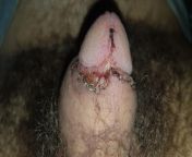 Is this infected? I&#39;m getting more pain on a morning than the last couple of days, after sleeping with my penis facing upwards towards my belly button as recommended rather than downwards from sleeping gand touch penis back si