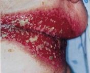 [50/50] (SFW) Wonderful Italian wild berry and lemon sorbetto &#124; (NSFW/L) Severe infected rash under the breasts of an old woman from indonesian nature old woman under 50