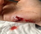 My son&#39;s hand after he squeezed his hand and cut it in an irongate at school. from sunny leone and cut mewap in video download unty moore xx