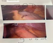 I had dor fundoplication yesterday and they gave me photos of the hernia before and after being fixed. The top photo shows the hernia being pulled through my diaphragm. from mypornsnap top photo