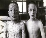 Children with smallpox in 1913; one vaccinated, the other not from smallpox