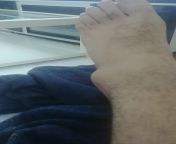 I just found out about this sub. I sprain my ankle like once every 2 years but my bones persevere. Here&#39;s my latest ankle sprain as an offering to my fellow milk drinkers. from cutegirl sprain ankle