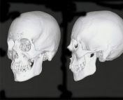 Do I need my jaw done? Postoperative CT scans from Facial Team. They told me my jaw was perfect and nothing was necessary, but retrospectively I wish I had had minor work done on the back corners of my jaw to adjust height and flaring. from cut scans from tarzan