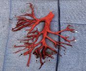 A 36-year-old man in California was admitted to the ICU for heart failure. After he was placed on blood thinners, he spat up a cast of his lungs right bronchial tree. from blak man in gril blood