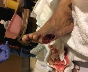 Father-In-Law had his pinky toe removed due to a blister turned ulcer (details in comments) from japanese father in law fucking his daughter sex