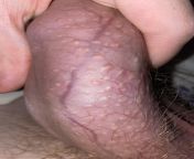 Welcome. i am 18 yrs old. i have never had sex (so it cant be STD) but my penis is full of these kind of spots ( I call them pimples) What should i do? Its ugly and irritating. Please help me from la penetre in quarantine should not do it but do not repent