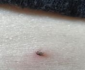 Can anyone help identify this tick? Spent the last 2 days in a forest in Lithuania, came back today (third day) and found this on my stomach. Lithuania has a high infestation rate. It was super tiny and looked like a mole before Ive zoomed in for this pi from sunny leone sex video in radian aunty in saree fuck a little