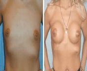Correction of tuberous breasts. (Fuck PCOS btw) from pcos