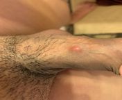 Do I have a std? Im a virgin and never had sex before. Any suggestions to treat this? from virgin and booty rape sex styli