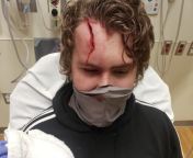Head opened after bycicle crash from bycicle lacing