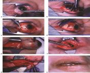 Picture showing the steps to Enucleation surgery (REMOVAL OF EYEBALL FR0M ORBIT/NSFL) from hot saree removal of tamil actor
