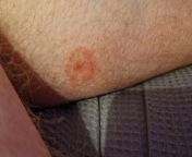 Live in Western Greater London area, got this bite some time last week. this pic is new, it&#39;s not painful, but it itches in the inflamed area. from raducanu in china greater bay area