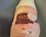 3 day post-op, don&#39;t know what to do about the sani-tape from sani lawan xa
