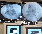 Chronic pain, scoliosis confirmed. Before and after epidural. Thoughts, opinions? from scoliosis brace