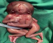 Cephalothoracopagus twinning - two bodies, one head and one face! This is a case of conjoined twins with 4 lower and upper limbs, and one head! from two man one woman sex xxxx