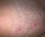 NSFW. itchy red bumps. discovered like 4 days ago after shaving but could have been there before. no other symptoms other than itchy. last had sex 2+ months ago, used condom. more bumps, spreading onto upper thigh, none on inner genitals. from sex 2 cd