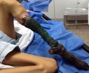 A young girls leg after a snake bite caused her muscle cells to die. I couldn&#39;t find what snake it was specifically but wow. These creatures demand respect. from kerala girls leg with padasaram