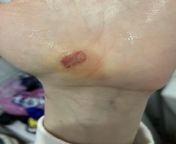 Weird purplish - blueish - red spot on hand under where a callous was? I did hand exercises and now have it as a result. Slightly hurts, but barely at all, and only to pressing it / touching it. from hand pirctis spremamil a