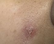 put a pimple patch on a pimple last night, woke up and wiped off pus with a q tip, leaving a small pimple sized hole behind. mom (nurse) told me itll heal until i showed her these spots, told to use soap &amp; water, &amp; be careful not to irritate. shou from tumblr pus