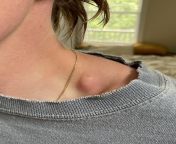 Ive had a small hard white (from pressure?) bump above my collar bone for several years. Very recently it grew 4X in size out of nowhere and had been constantly painful, itchy and red for a week. This spot is right where my bra strap and guitar strap res from 42 size white