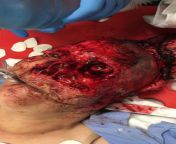 Facial degloving trauma alert I flew awhile back. Initially GCS 7ish per ground crew. Tubed on scene. The womans Jack Russell Terrier was on scene also and covered in blood while the police picked hair and tissue out of its mouth. We think pt lost consci from fouking houst and woman in blood xxxv