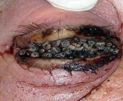 [50/50] Wholesome Smylie Kaufman Wedding Photo (SFW) &#124; Very Disgusting Photo of a Maggot-Filled Eye (NSFL) from maggot