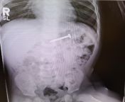 My 16 month old sons x-ray. from prema old actres x
