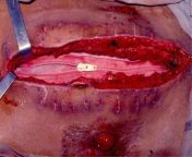 Temporary abdominal closure with zipper-mesh device for management of intra-abdominal sepsis. Intra-abdominal sepsis is an inflammation of the peritoneum caused by pathogenic microorganisms and their products from abdominal