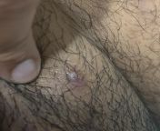 [19M] bump on my mons pubis, looks like maybe an ingrown or a cyst? Anyone know what this could be? from mons pubis clitoris vulva perineum