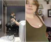 First pic: last Tuesday day of surgery (June 30th 2020) second pic: Wednesday 8 days post-op (July 8th 2020). Started as a 42G I have no clue what I am now. I love them best thing I&#39;ve ever done! Btw that&#39;s bandages in my bra. from png 2020